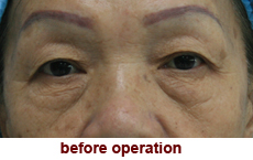 plastic-surgery-blepharoplasty